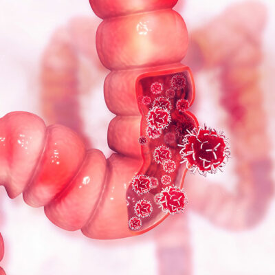 4 Effective Treatment Options for Colon Cancer