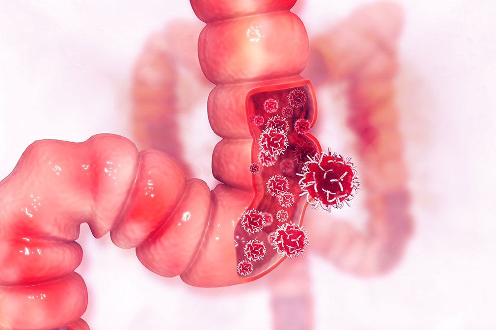 4 Effective Treatment Options for Colon Cancer