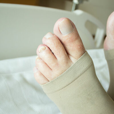 5 Commonly Asked Questions About Compression Socks for DVT