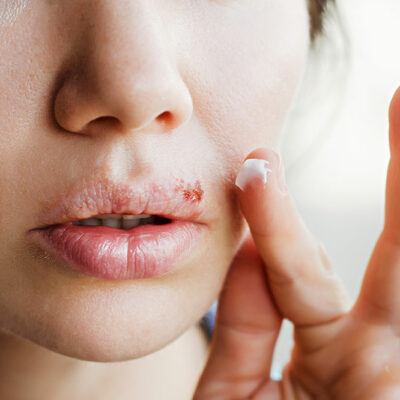 6 Tips to Prevent Cold Sores