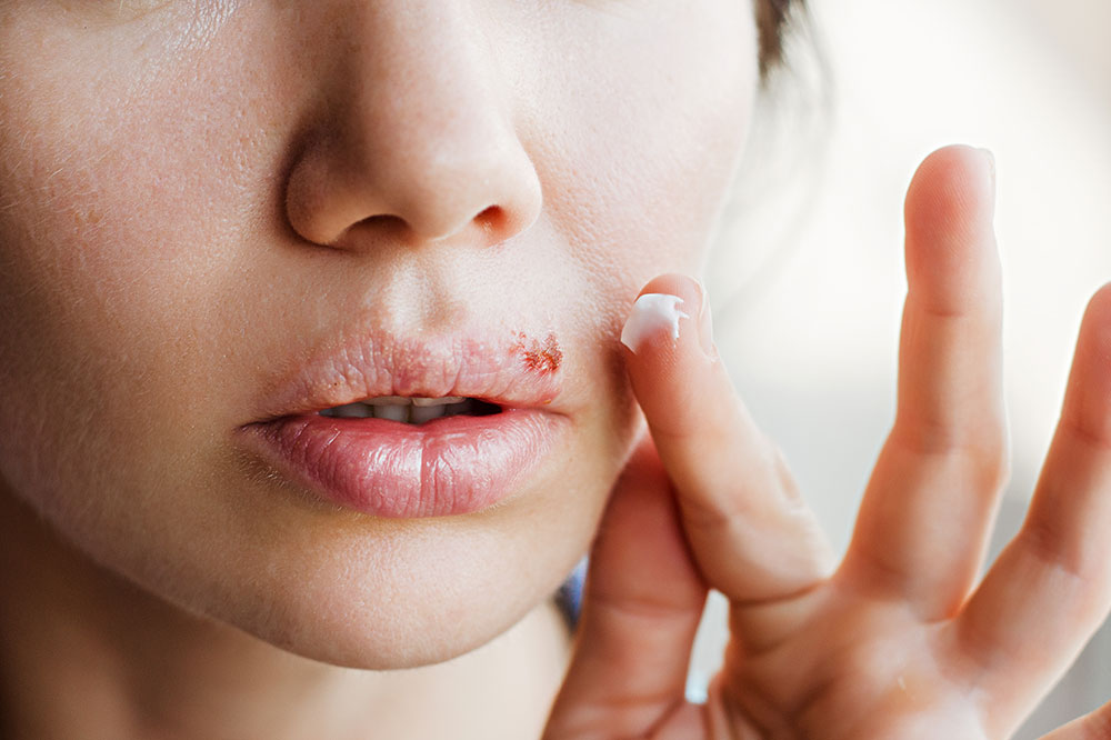 6 Tips to Prevent Cold Sores