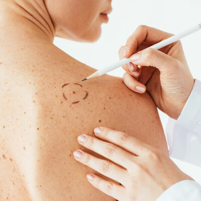 Causes and Risk Factors for Melanoma