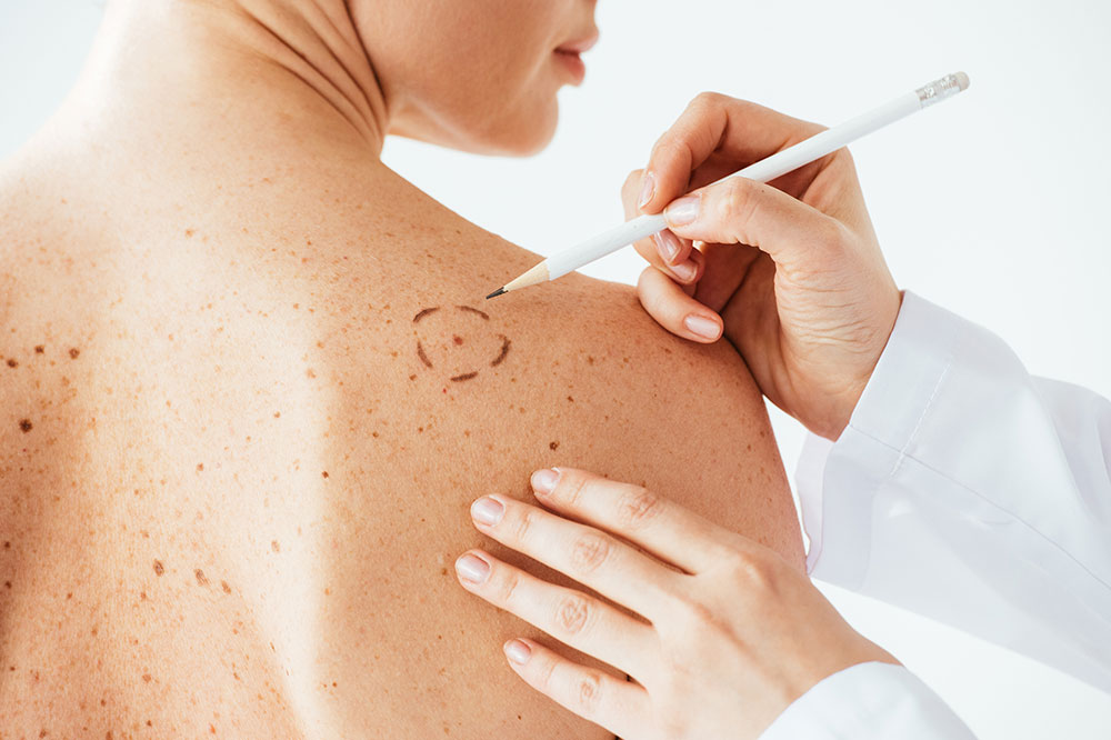 Causes and Risk Factors for Melanoma