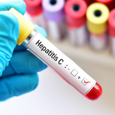 Hepatitis C &#8211; Risk Factors and Prevention