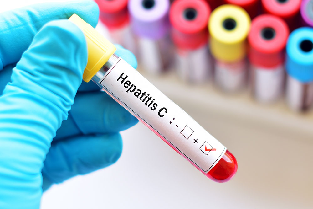 Hepatitis C &#8211; Risk Factors and Prevention