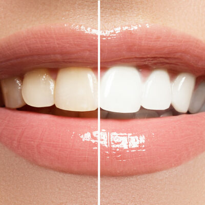 Pros and Cons of Teeth Whitening