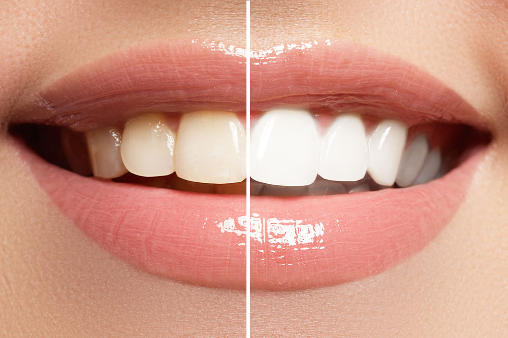 Pros and Cons of Teeth Whitening